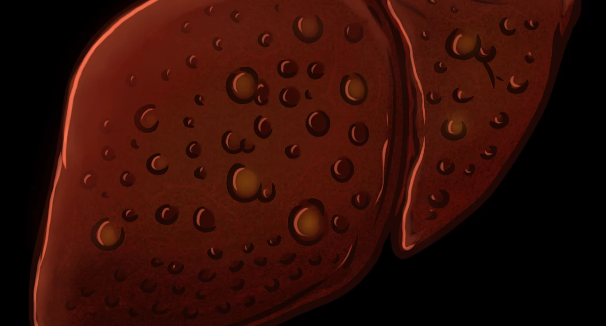 Coraz więcej Polaków choruje na wątrobę. To nie alkohol jest główną przyczyną!