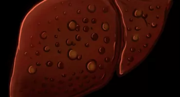 Coraz więcej Polaków choruje na wątrobę. To nie alkohol jest główną przyczyną! 